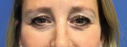 Blepharoplasty Before & After Patient #1838