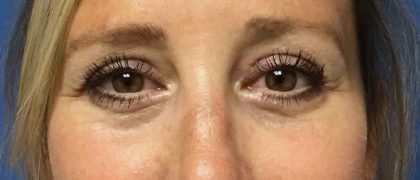 Blepharoplasty Before & After Patient #1838