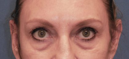 Blepharoplasty Before & After Patient #1851