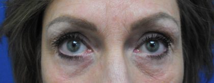 Blepharoplasty Before & After Patient #1851