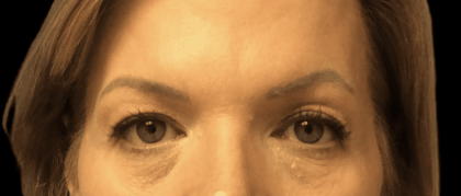 Blepharoplasty Before & After Patient #1857