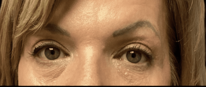 Blepharoplasty Before & After Patient #1857