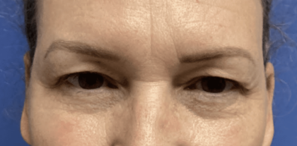 Blepharoplasty Before & After Patient #1860