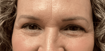 Blepharoplasty Before & After Patient #1860