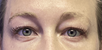 Blepharoplasty Before & After Patient #1863