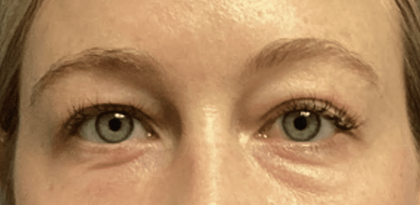 Blepharoplasty Before & After Patient #1863