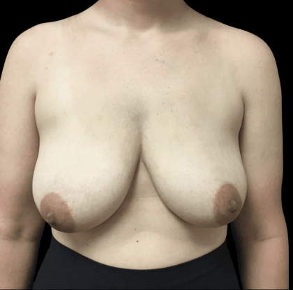 Breast Augmentation Before & After Patient #268