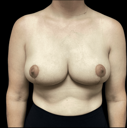 Breast Augmentation Before & After Patient #268