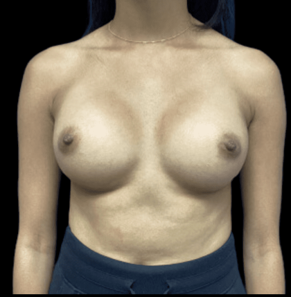 Breast Augmentation Before & After Patient #318