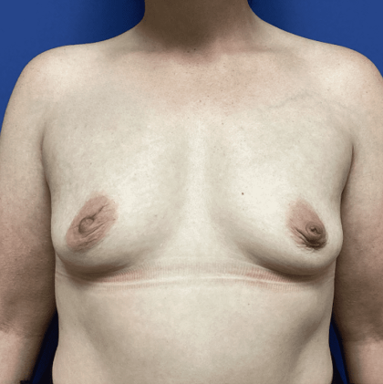 Breast Augmentation Before & After Patient #358