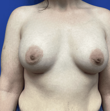 Breast Augmentation Before & After Patient #358