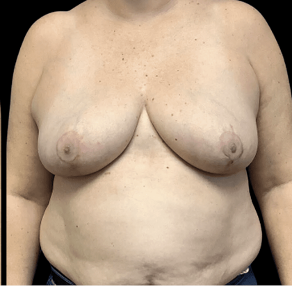 Breast Reduction Before & After Patient #1444