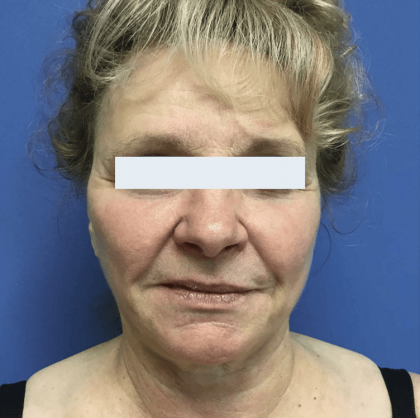 Facelift Before & After Patient #1775