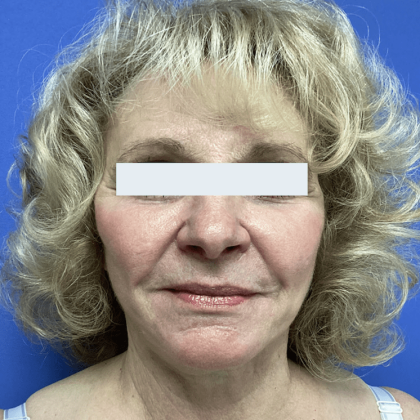 Facelift Before & After Patient #1775