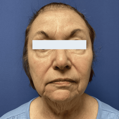 Facelift Before & After Patient #1780