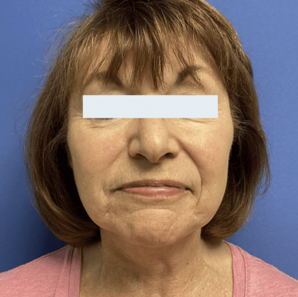 Facelift Before & After Patient #1780