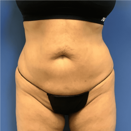 Tummy Tuck Before & After Patient #2522