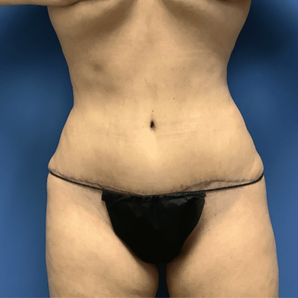 Tummy Tuck Before & After Patient #2522