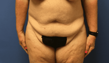 Tummy Tuck Before & After Patient #2544