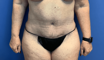 Tummy Tuck Before & After Patient #2544