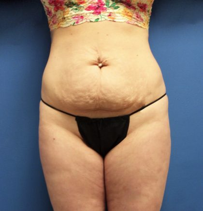 Tummy Tuck Before & After Patient #2624