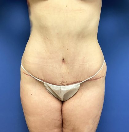 Tummy Tuck Before & After Patient #2624