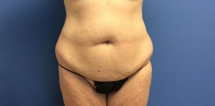 Tummy Tuck Before & After Patient #2664