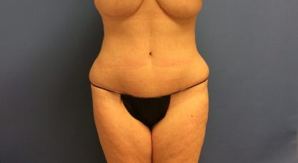 Tummy Tuck Before & After Patient #2664