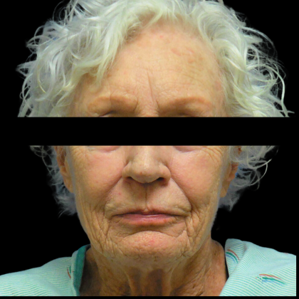 Facelift Before & After Patient #4029