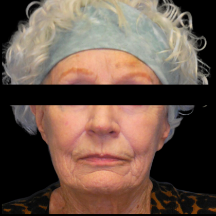 Facelift Before & After Patient #4029