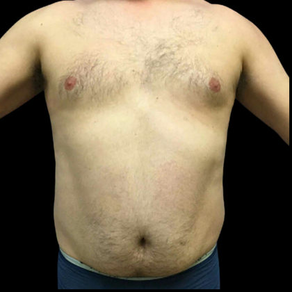 Liposuction Before & After Patient #4032