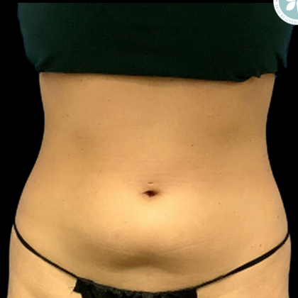 Liposuction Before & After Patient #4350