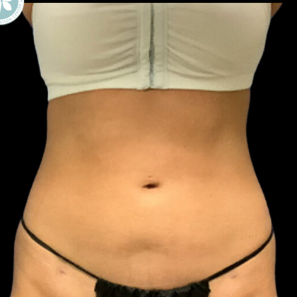 Liposuction Before & After Patient #4350